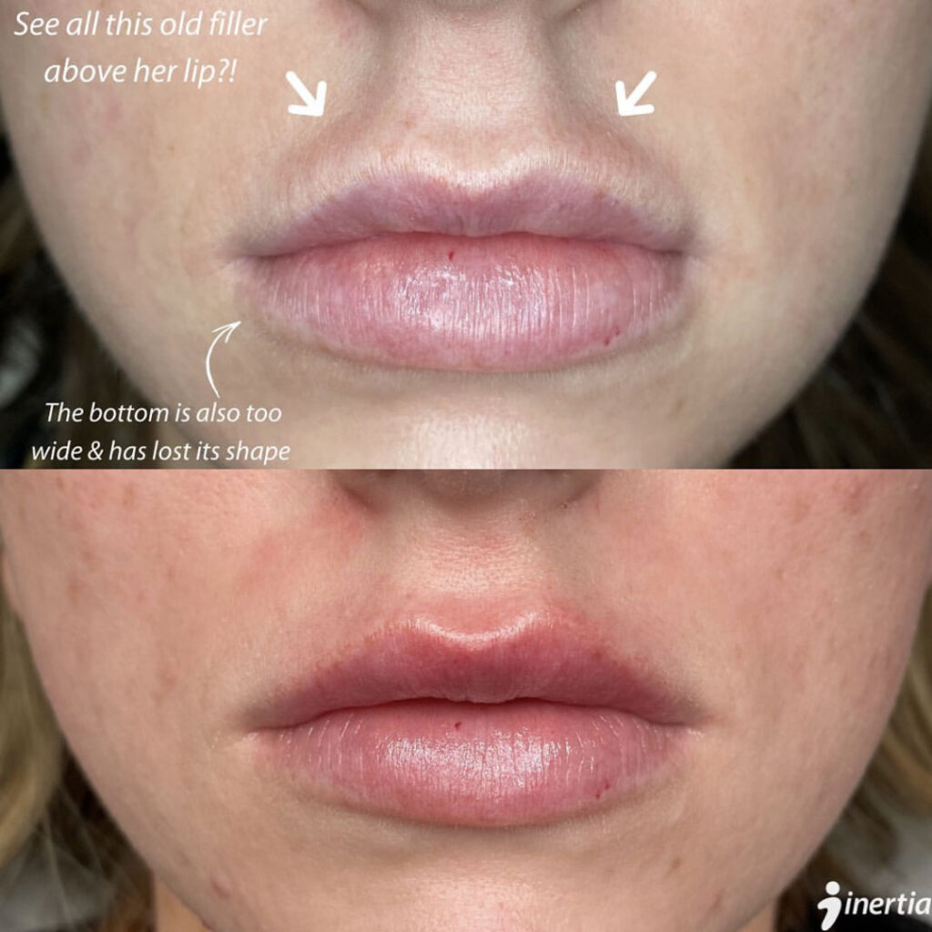 Before and After Filler Dissolver Photo Gallery Remarkable Results