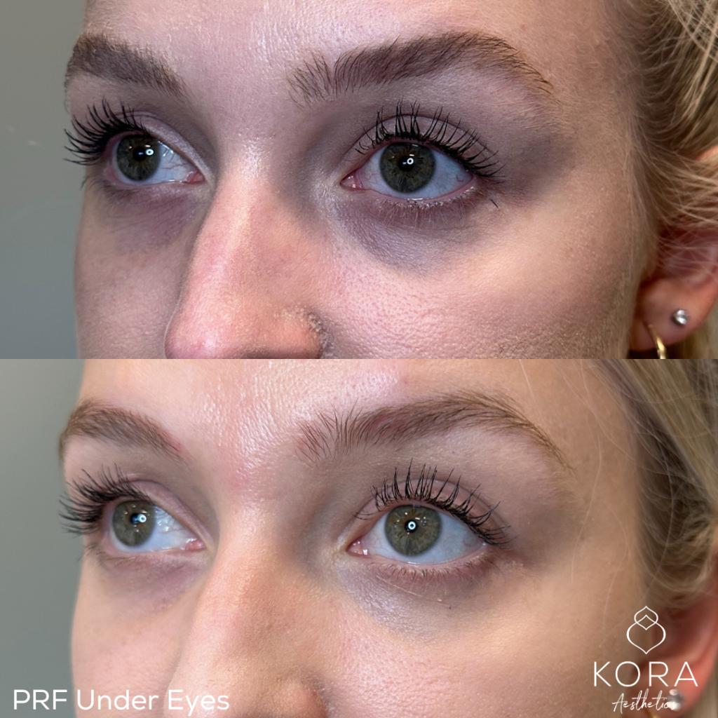 Under eye circles removed
