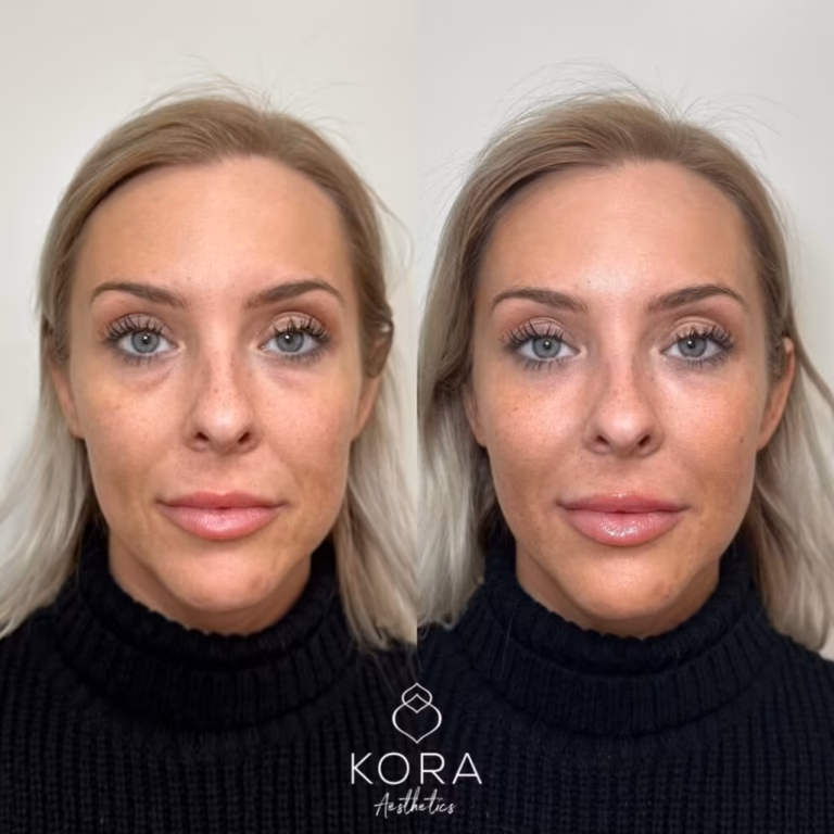PRF EZ Gel patient #432 before and after