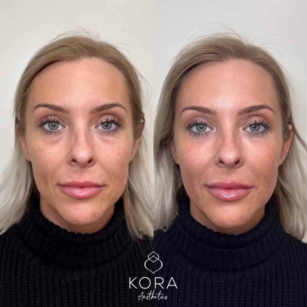 Before and after full face PRF EZ Gel treatment showing under-eye hollow reduction and cheek volume restoration in Scottsdale