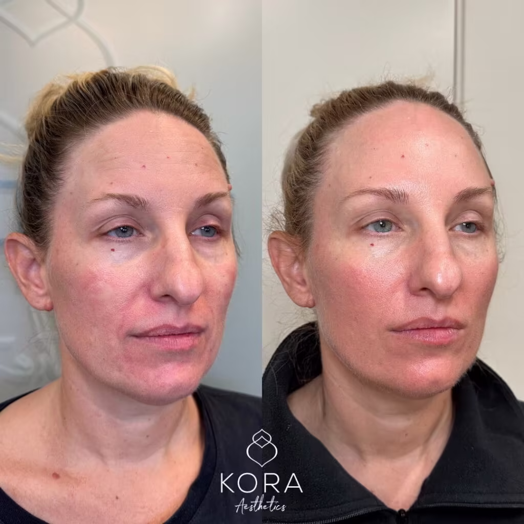 Angled before and after view showing under-eye rejuvenation and smooth skin texture after PRF EZ Gel in Scottsdale