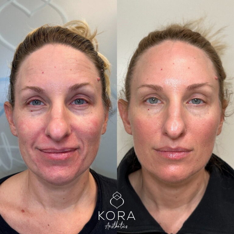 PRF EZ Gel patient #313 before and after