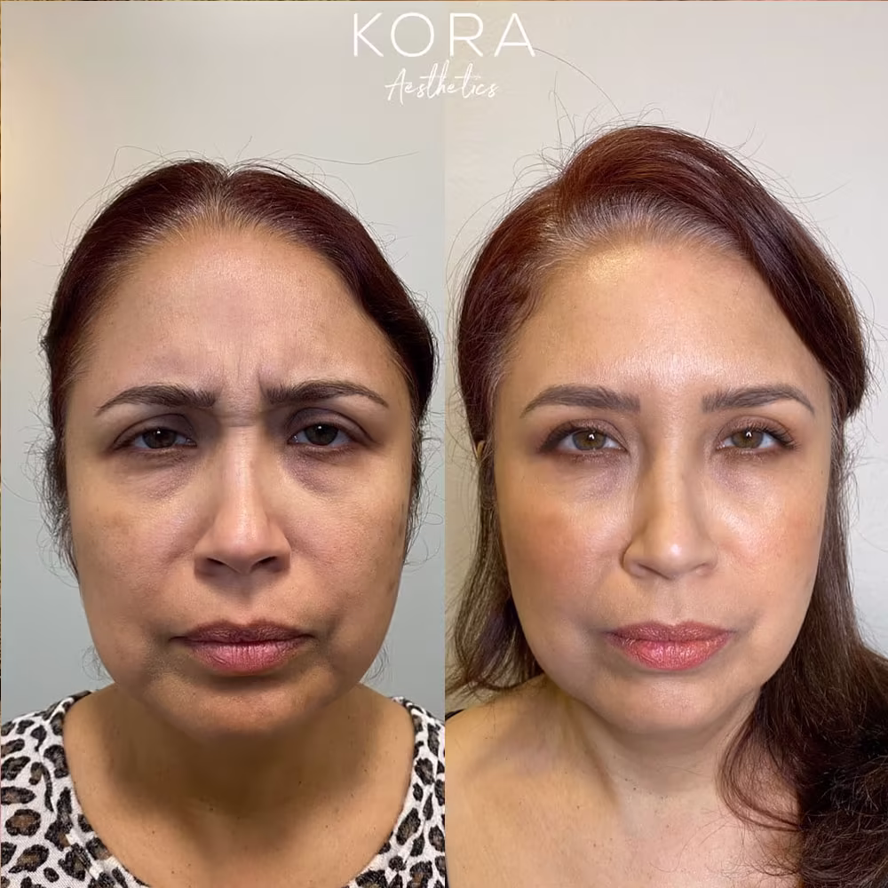 Before and after comparison showing smoothed glabellar frown lines between the brows following Botox treatment in Scottsdale