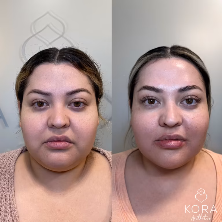 Juvéderm Smile Lines patient #353 before and after