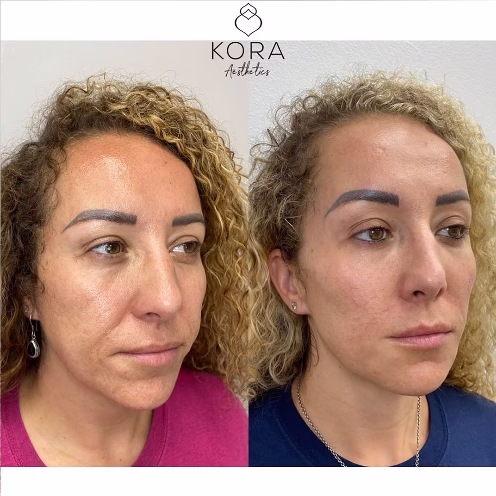Three-quarter angle before and after dermal filler smoothing deep smile lines in Scottsdale