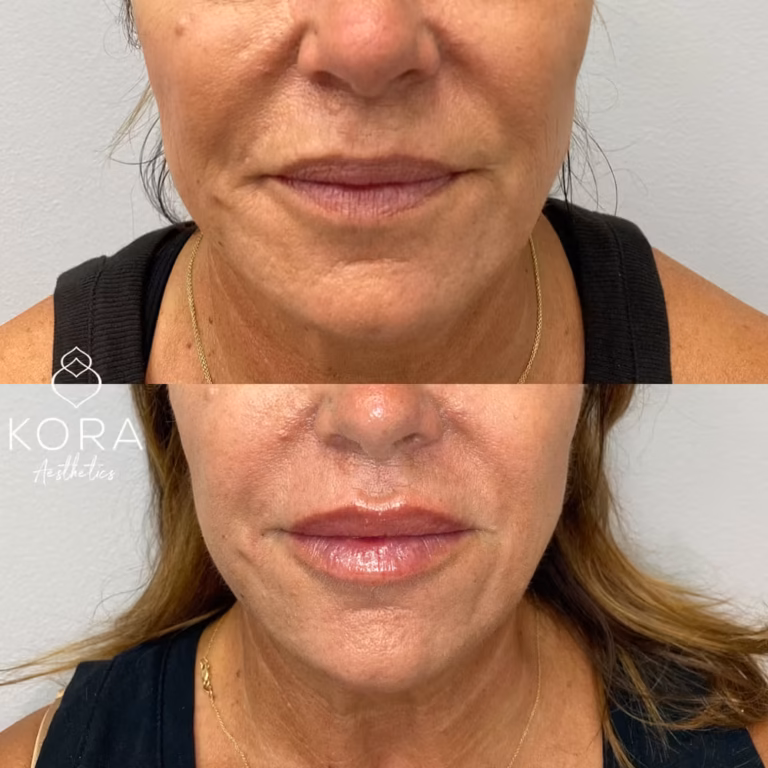 Juvéderm Smile Lines patient #354 before and after