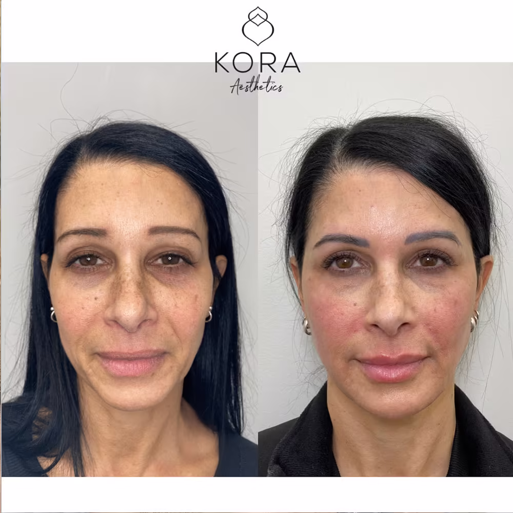 Frontal view before and after dermal filler softening deep smile lines and mid-face hollows in Scottsdale