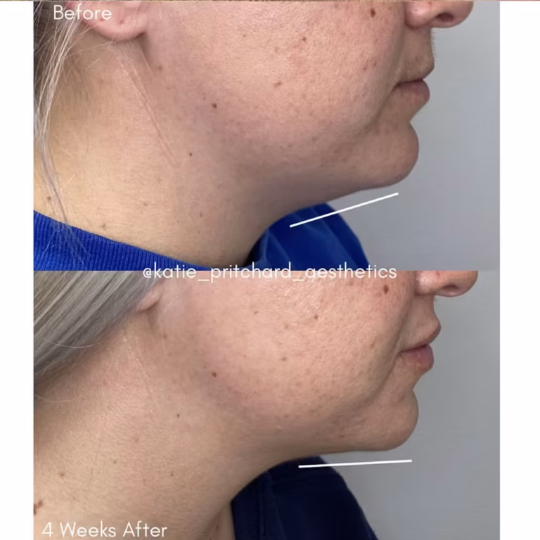 Kybella Double Chin patient #380 before and after