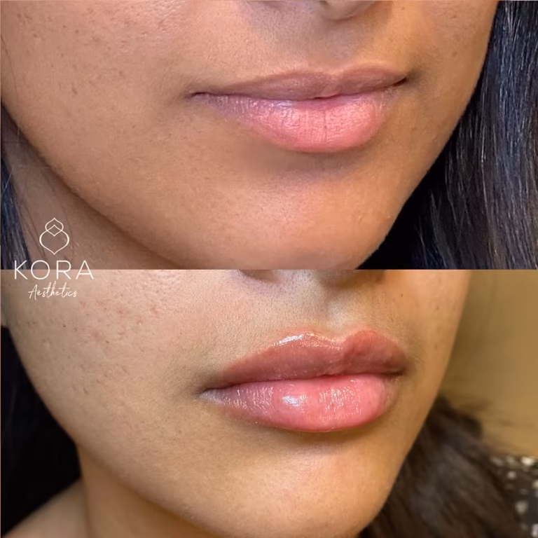 Lip Filler patient #435 before and after