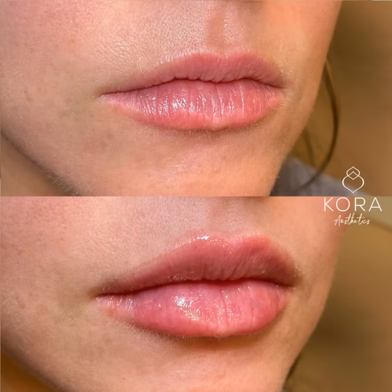 Lip Filler patient #378 before and after