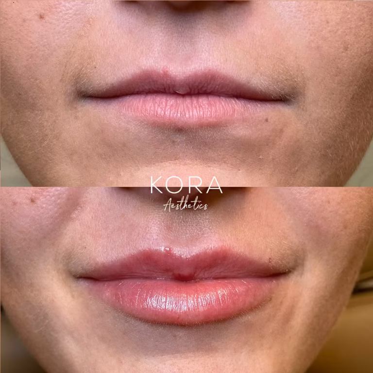 Lip Filler patient #425 before and after