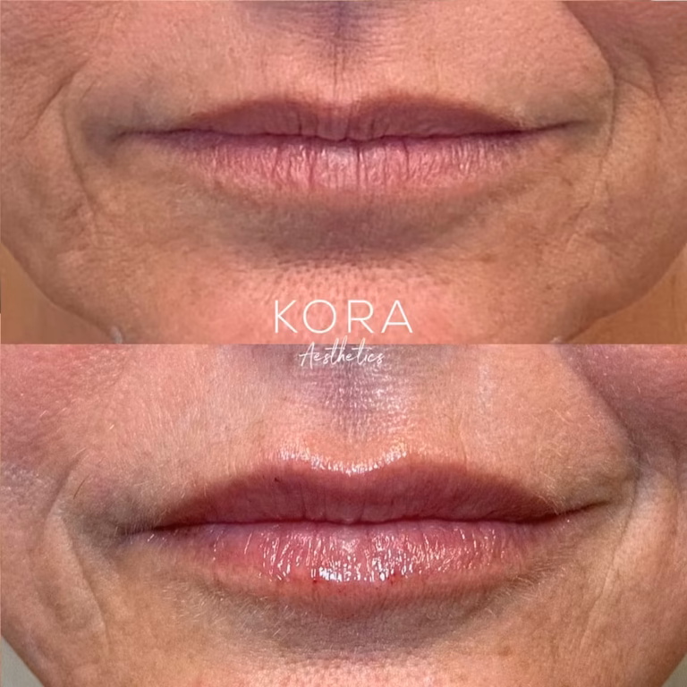 Lip Filler patient #426 before and after