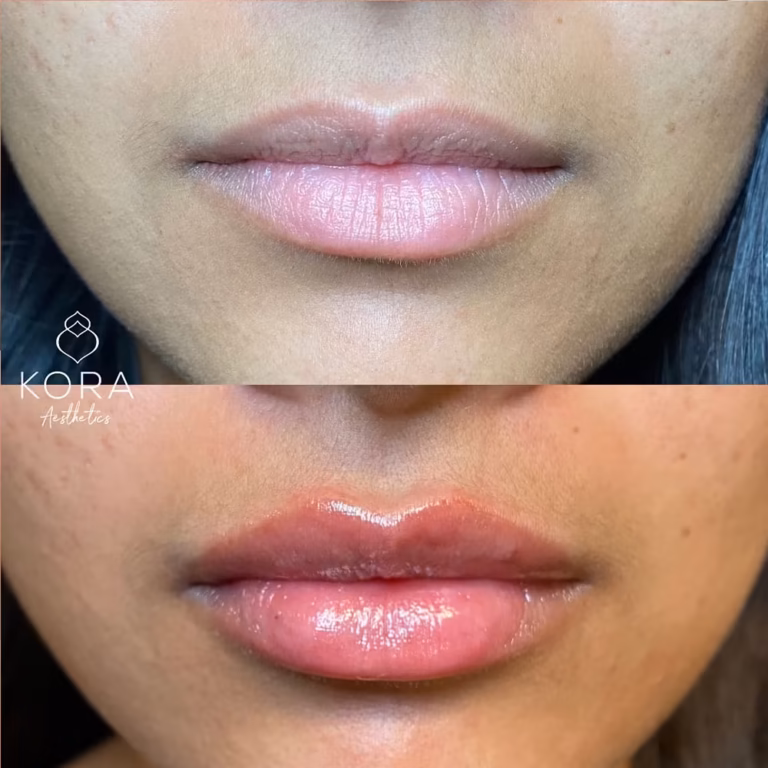 Lip Filler patient #427 before and after
