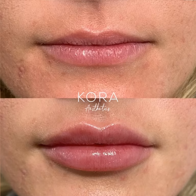 Lip Filler patient #420 before and after