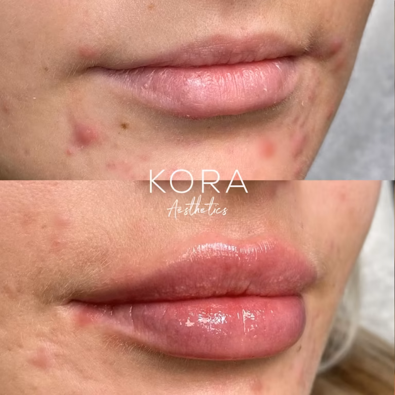 Lip Filler patient #428 before and after