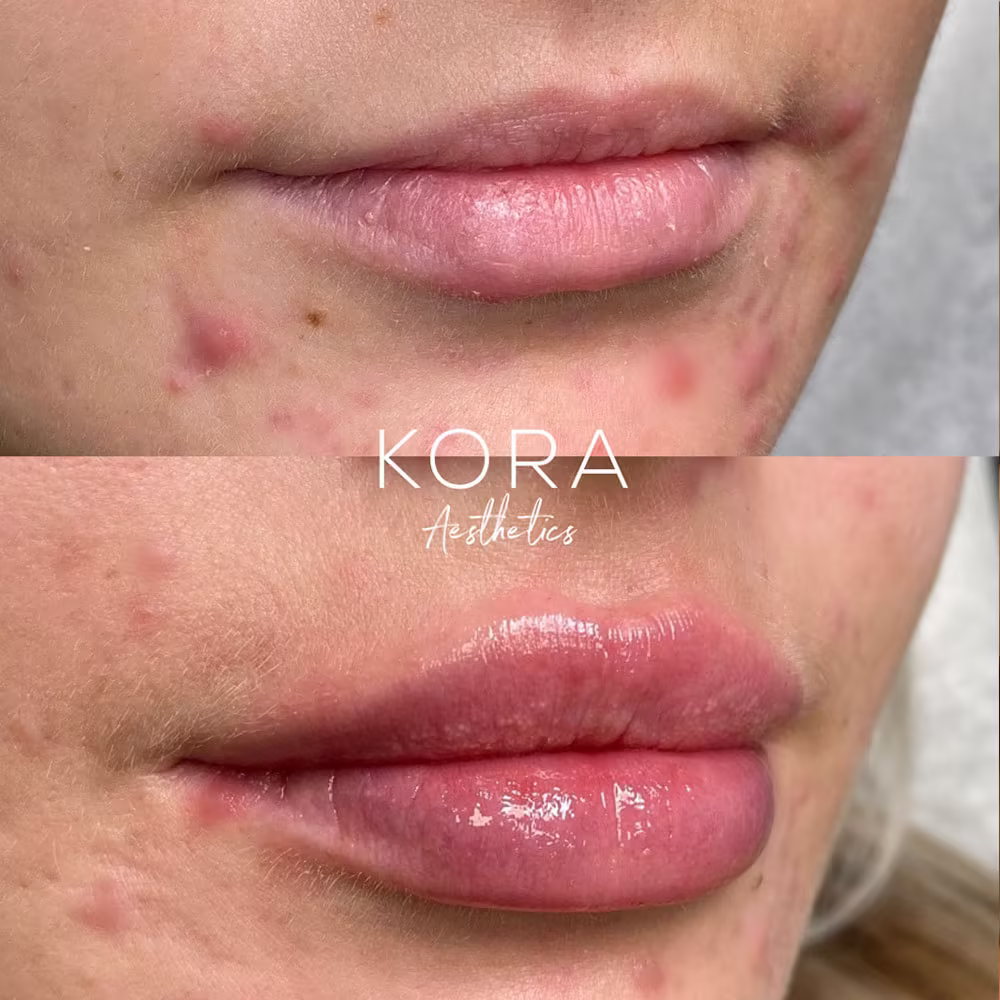Side angle before and after of lip filler treatment showing improved lip projection and volume in Scottsdale
