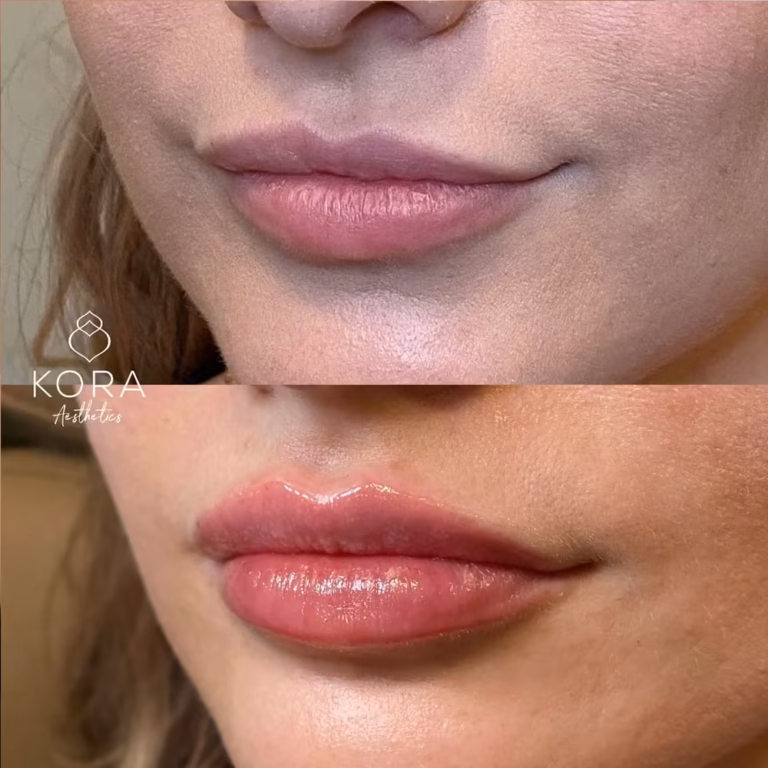 Lip Filler patient #421 before and after