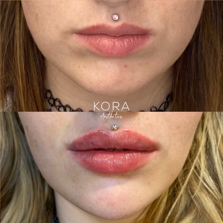 Lip Filler patient #431 before and after