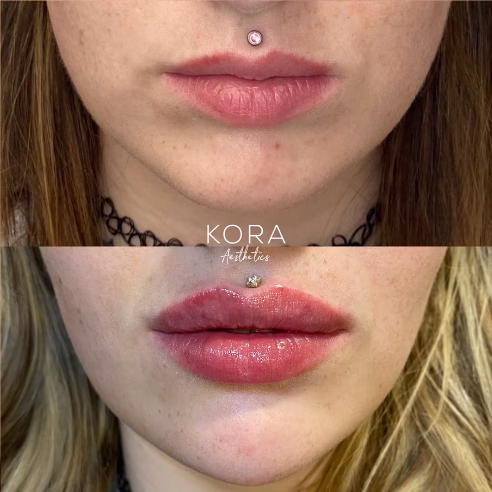 Before and after lip enhancement showing plumper lips and accentuated Cupid's bow in Scottsdale
