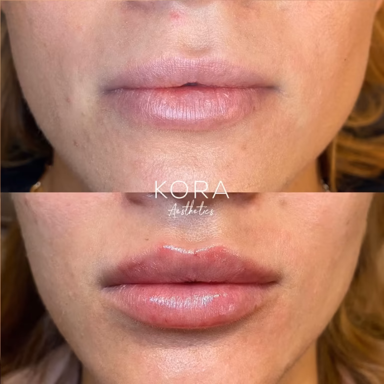 Lip Filler patient #422 before and after