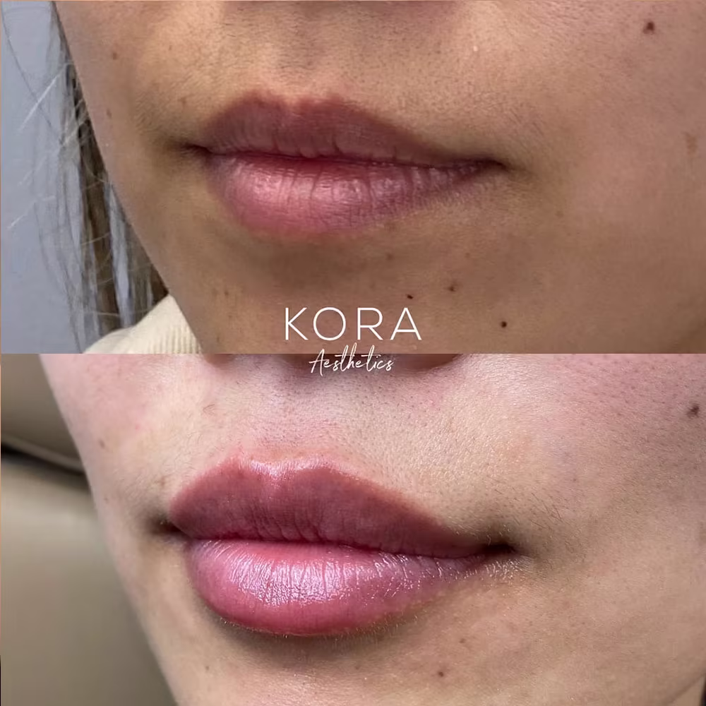 Angled view before and after lip filler treatment showcasing enhanced lip plumpness in Scottsdale