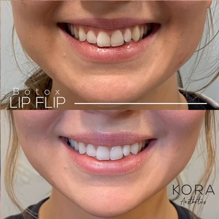 Lip Flip patient #379 before and after