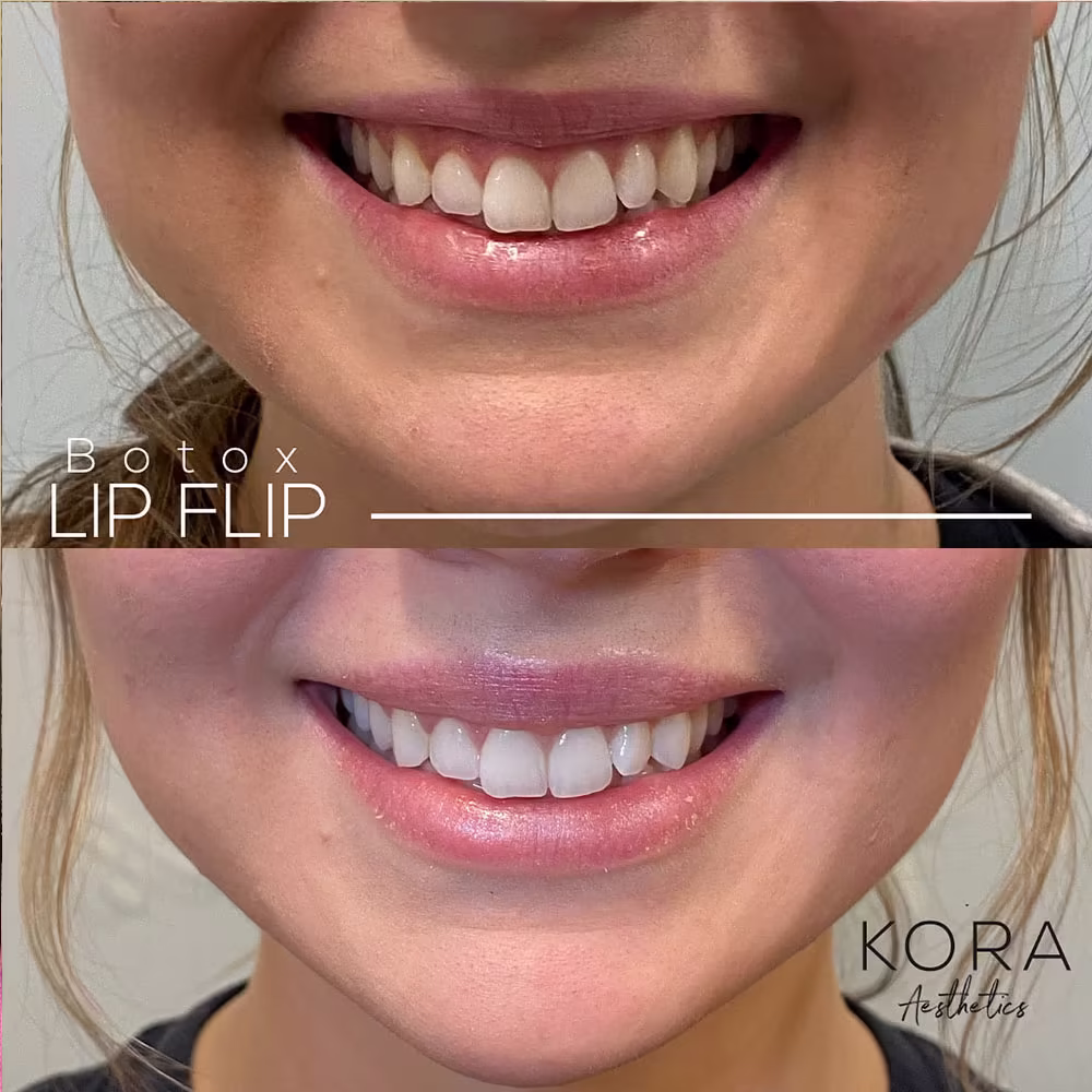 Before and after comparison showing increased upper lip fullness and reduced gummy smile following a Botox lip flip treatment in Scottsdale