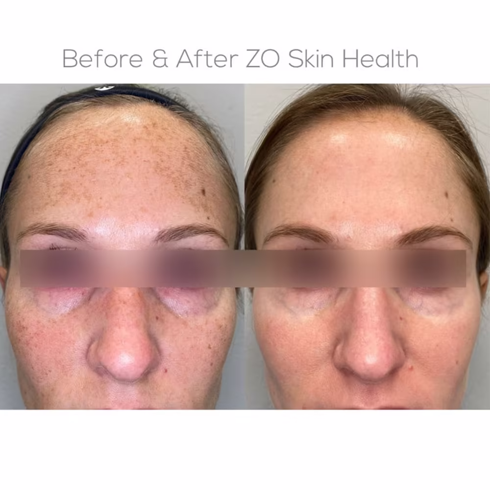 Frontal before and after view displaying dramatic reduction in forehead sun damage and freckling after medical-grade skincare in Scottsdale