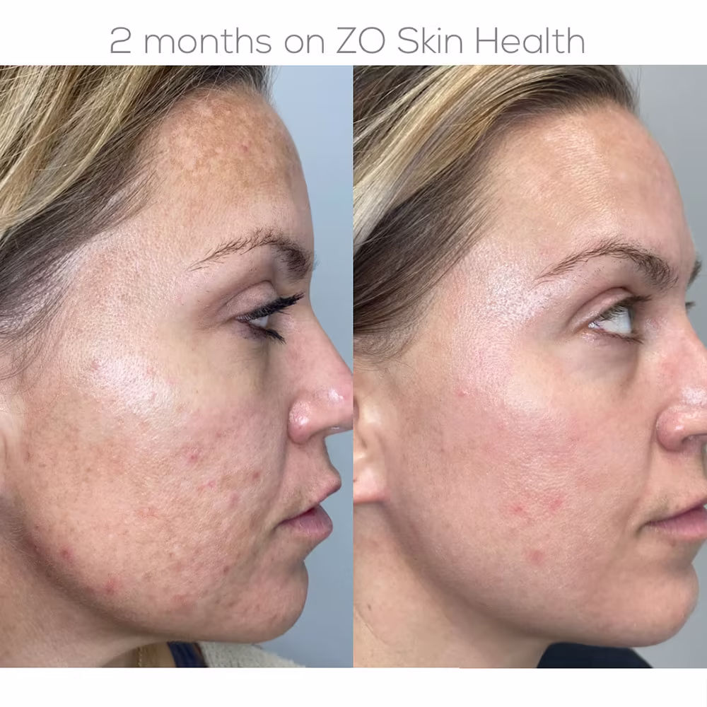Profile view demonstrating significant reduction in forehead pigmentation, acne breakout spots, and refined skin texture in Scottsdale