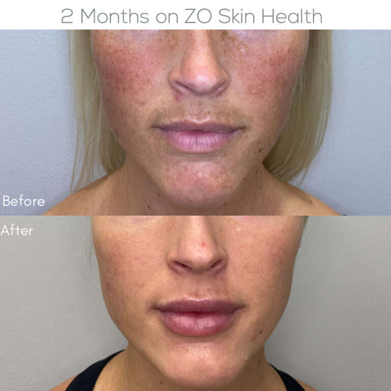 Medical-Grade Skincare patient #344 before and after