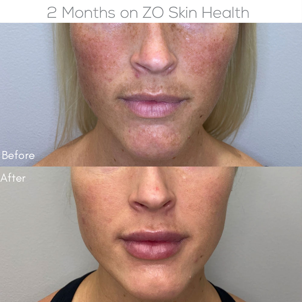 Before and after comparison showing visible reduction in facial hyperpigmentation and improved skin tone following ZO Skin Health medical-grade skincare in Scottsdale