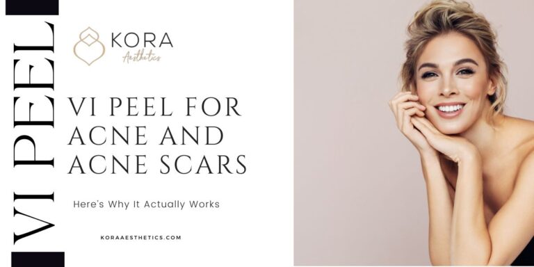 VI Peel for Acne and Acne Scars