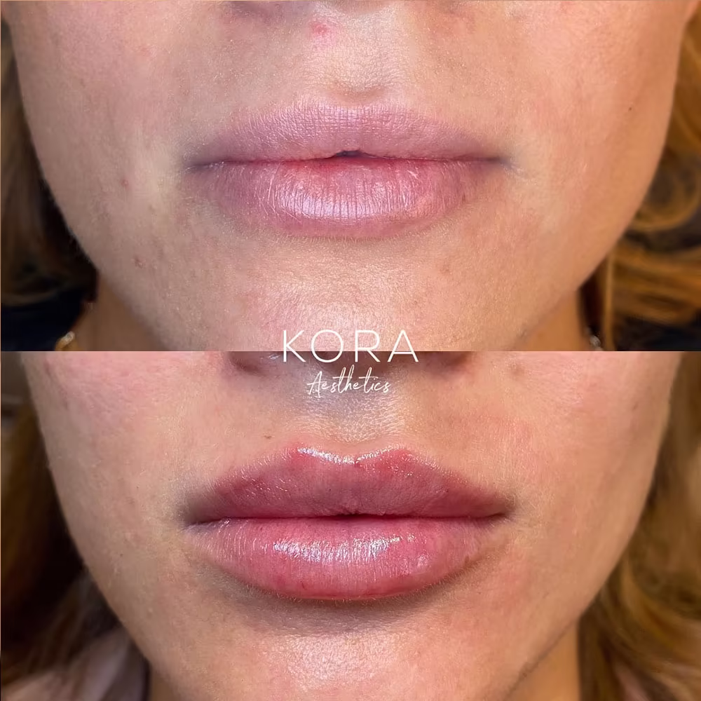 Before and after lip filler injection creating a fuller, more defined lip shape in Scottsdale