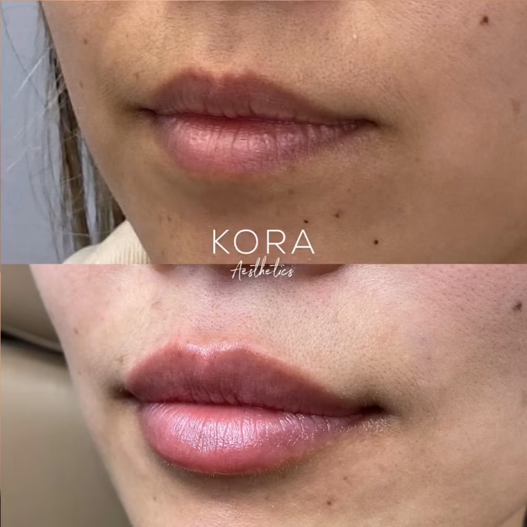 Dermal Filler Lips Fillers patient #411 before and after