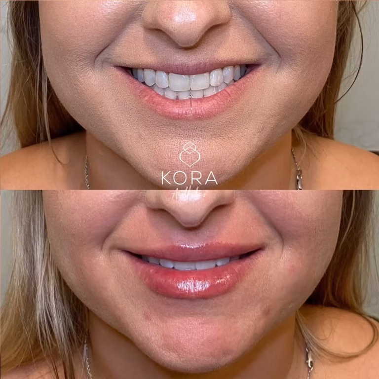 Dermal Filler Lips Fillers patient #404 before and after