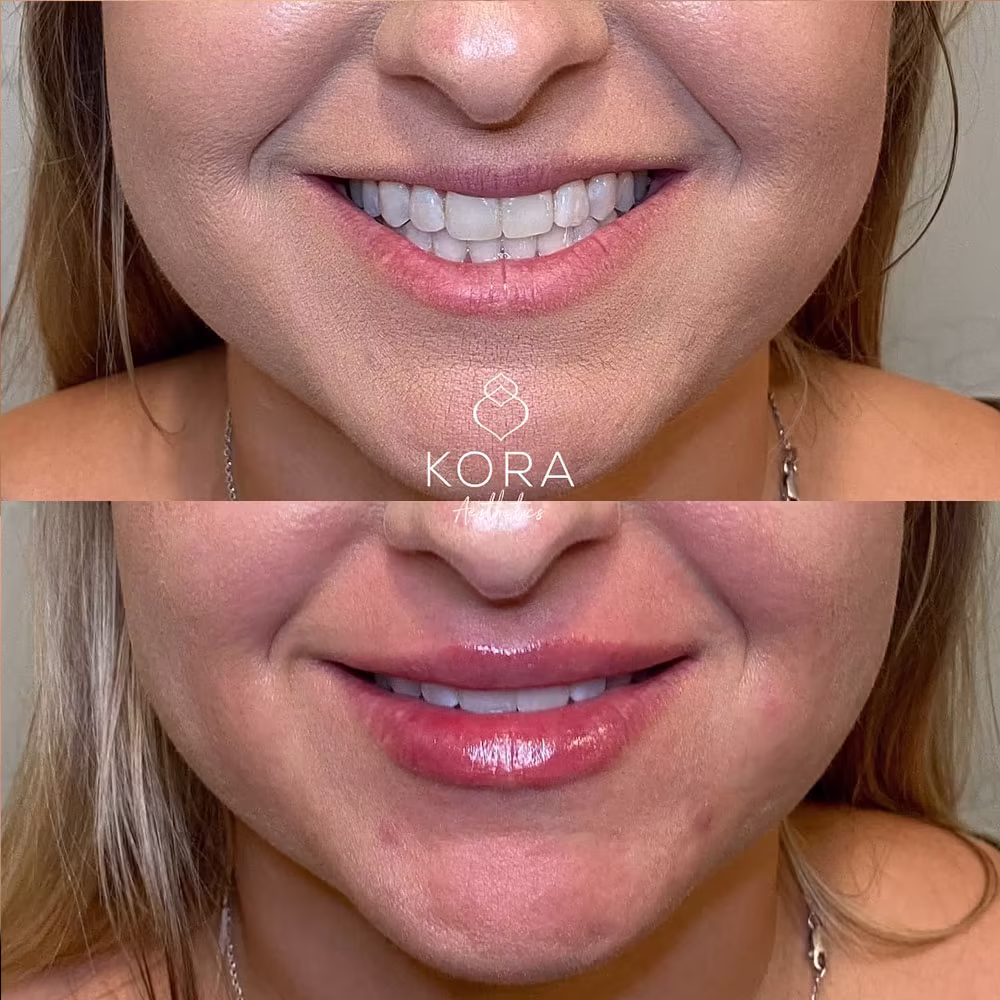 Before and after smiling comparison of lip filler treatment improving lip show and symmetry in Scottsdale