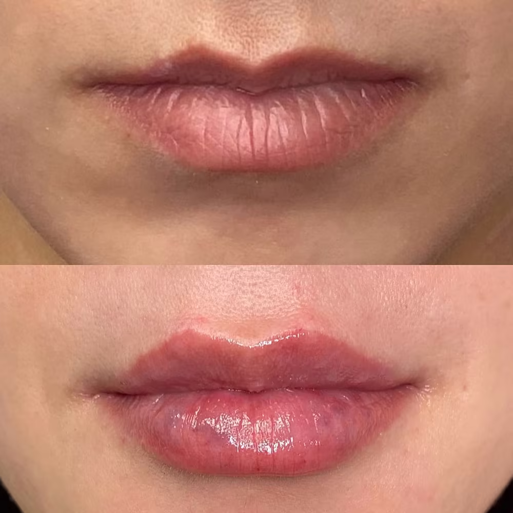 Before and after frontal photo of lip filler injection improving lip volume, shape, and definition in Scottsdale
