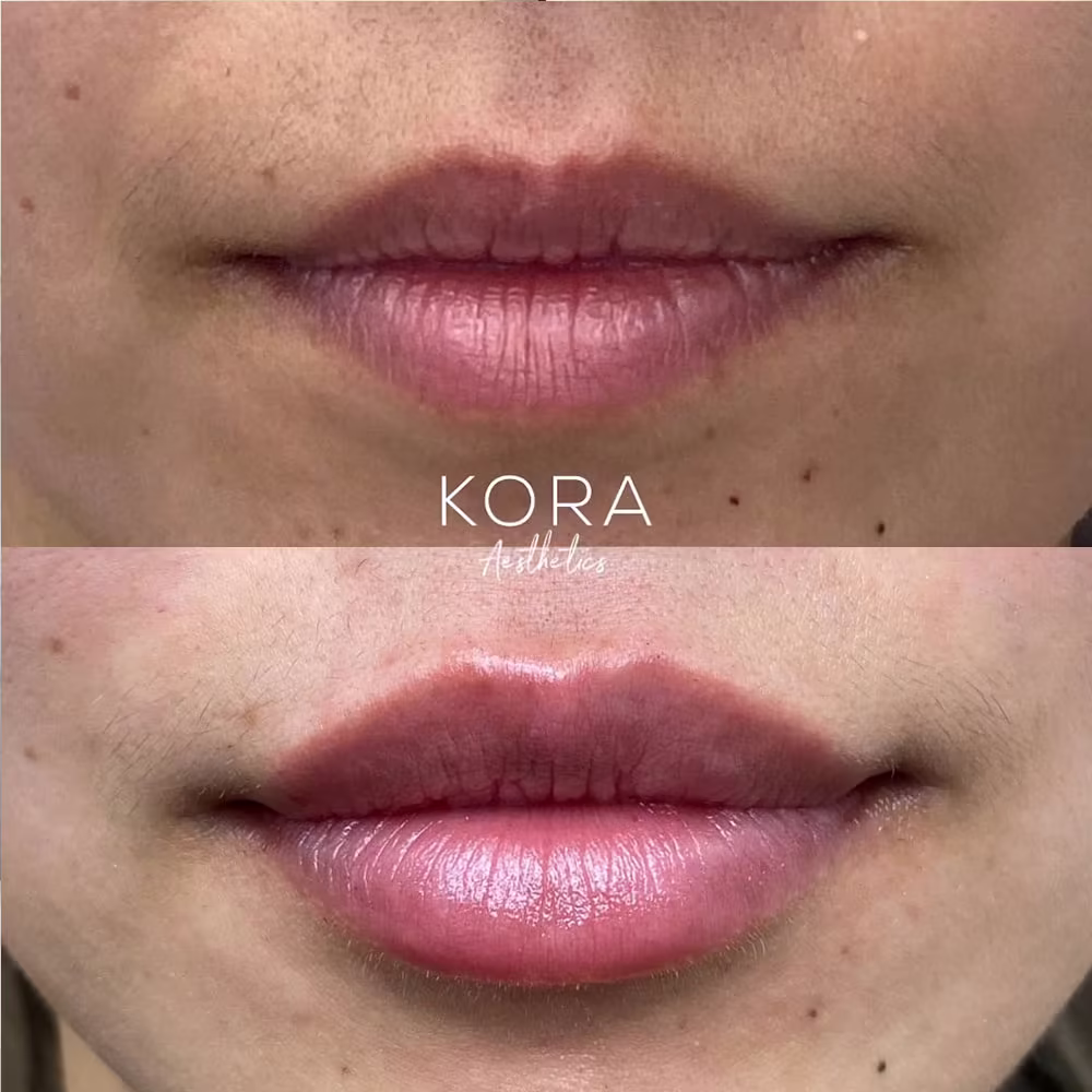 Before and after frontal photo of dermal lip fillers correcting thin lips and enhancing volume in Scottsdale