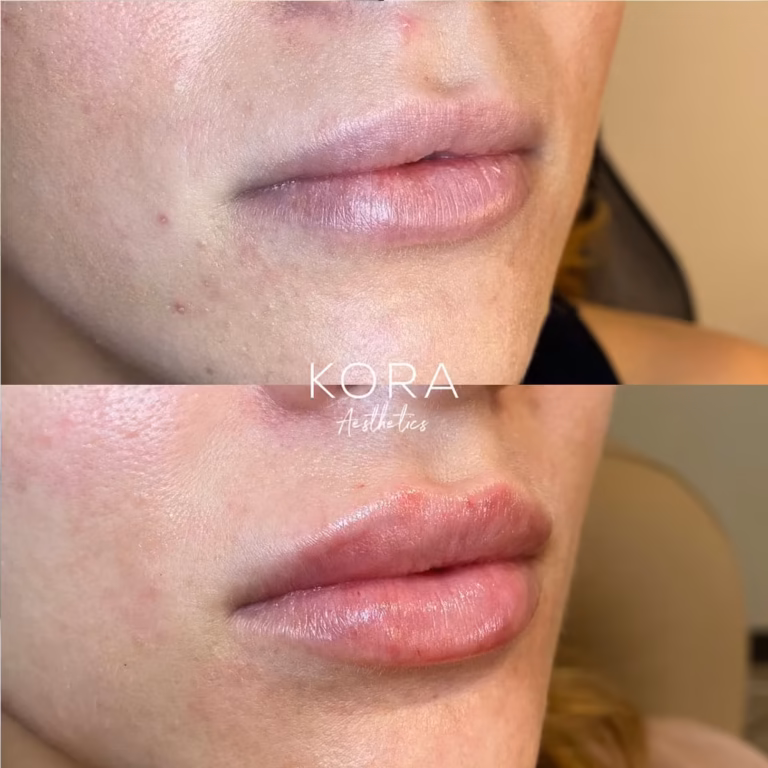 Dermal Filler Lips Fillers patient #409 before and after