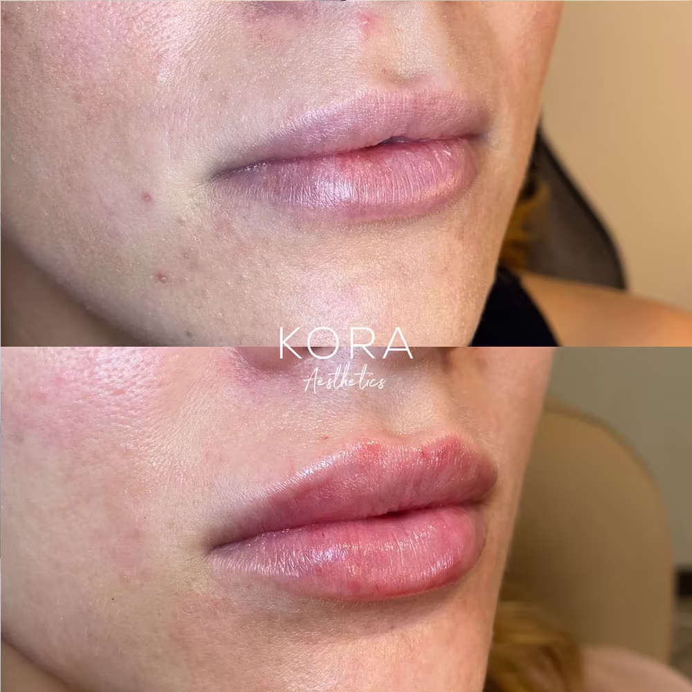 Before and after angled view of lip dermal fillers enhancing upper and lower lip projection in Scottsdale