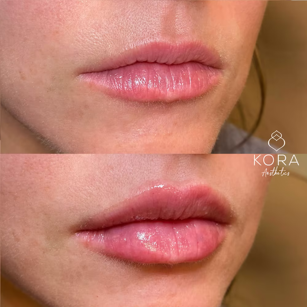 Before and after lip filler treatment showing improved lip plumpness and hydrated texture in Scottsdale