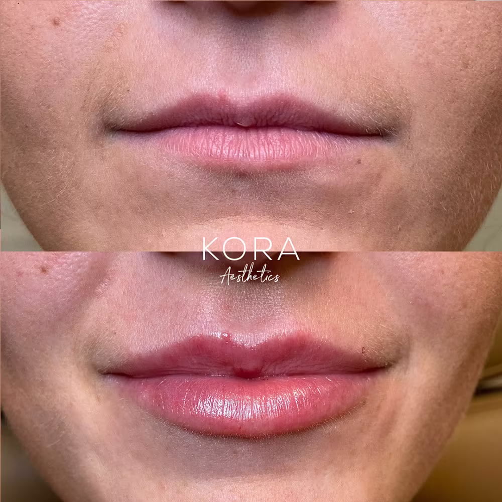 Before and after close-up photo of lip filler treatment expanding thin upper and lower lips in Scottsdale