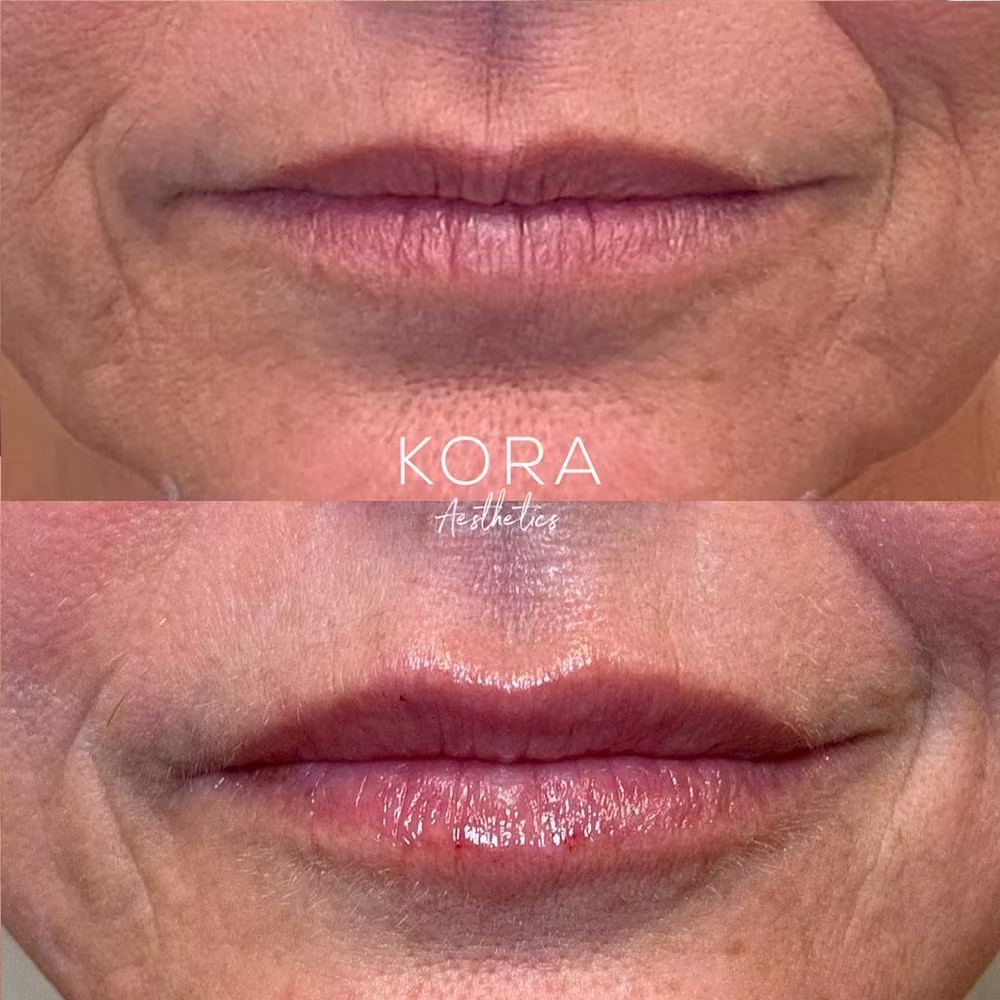 Before and after photo of lip dermal fillers softening perioral lines and adding lip volume in Scottsdale