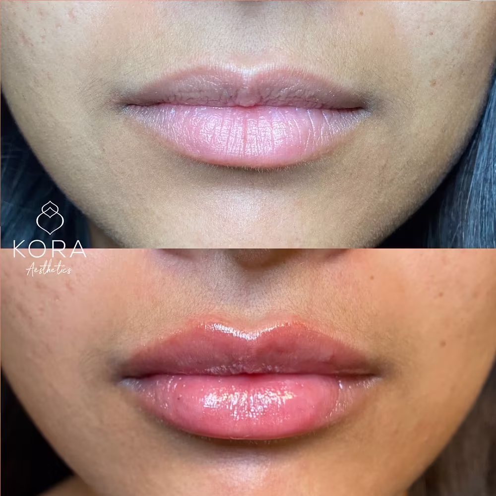 Before and after frontal view of lip filler injection defining the Cupid's bow and adding lip volume in Scottsdale