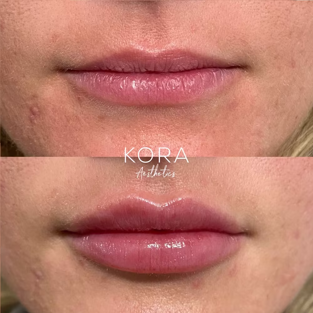 Before and after lip filler treatment enhancing upper lip border definition and overall lip symmetry in Scottsdale