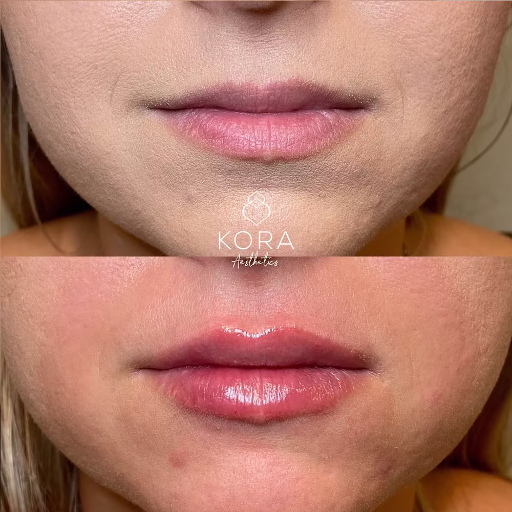Before and after lip augmentation showcasing enhanced upper lip definition and overall lip symmetry in Scottsdale