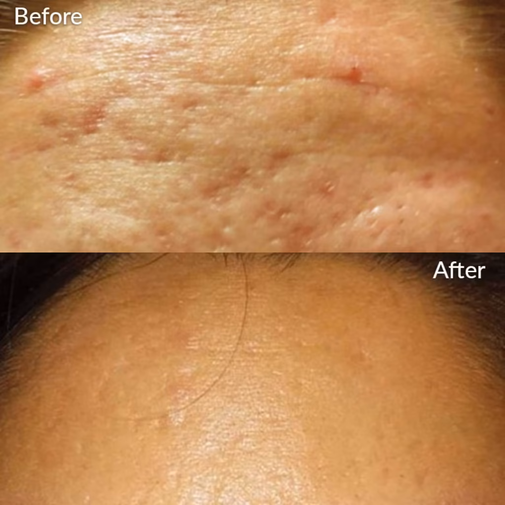 Before and after microneedling with PRF showing improved skin texture, smoother forehead acne scars, and refined pores in Scottsdale