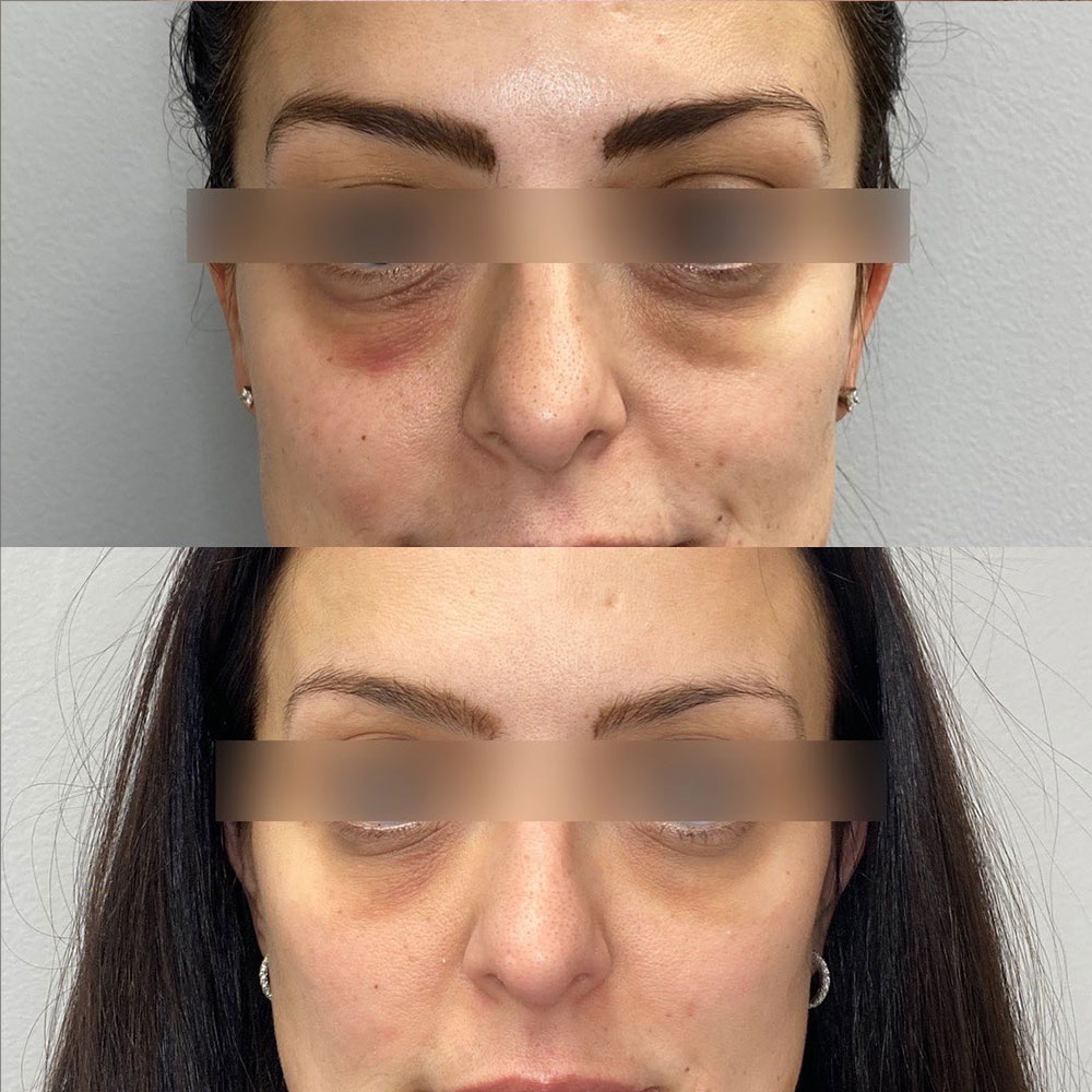 Before and after under-eye treatment comparison showing reduced dark circles, filled tear troughs, and improved skin tone in Scottsdale