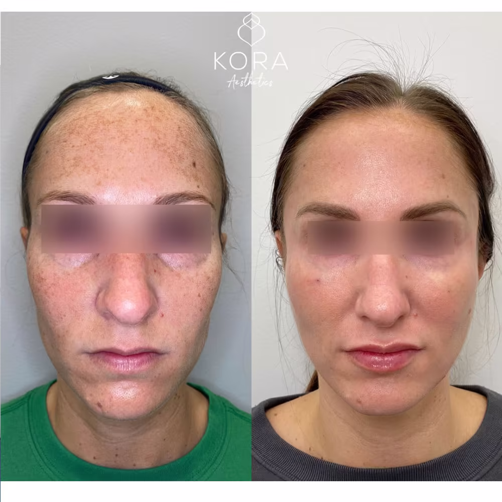 Before and after comparison showing improved facial volume, midface restoration, and refined cheek contours in Scottsdale