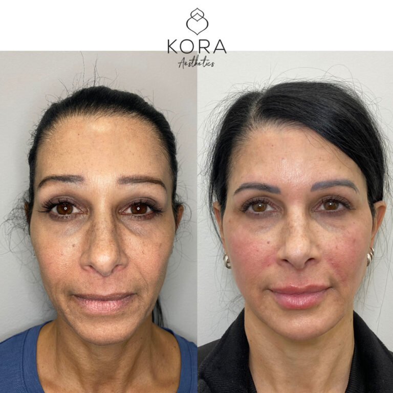 Sculptra Face & Neck patient #304 before and after